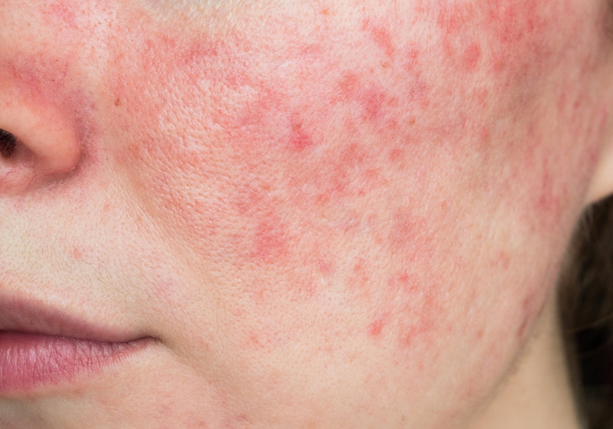 Skincare for Rosacea
