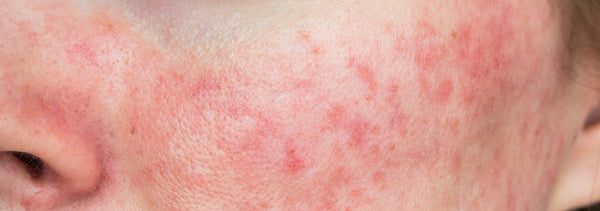 The Best Rosacea Skincare Routine | Expert Advice for Sensitive Skin