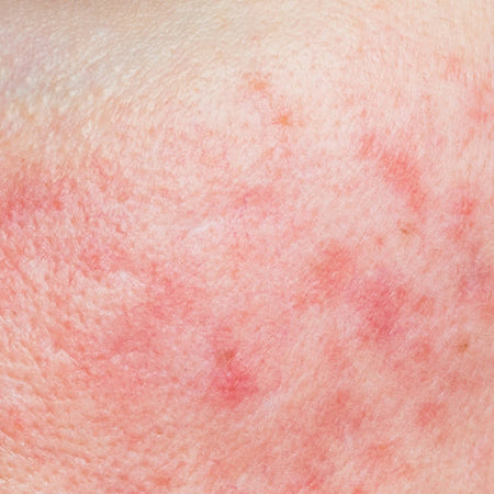 The Best Rosacea Skincare Routine | Expert Advice for Sensitive Skin