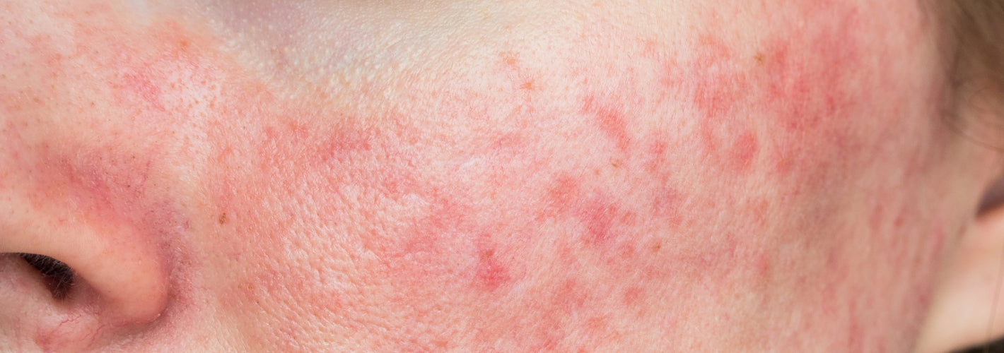 The Best Rosacea Skincare Routine | Expert Advice for Sensitive Skin