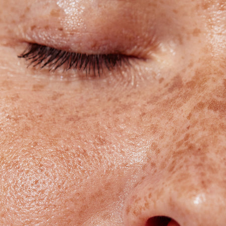 Pigmentation & Hyperpigmentation: Why It Happens and How to Treat It Safely