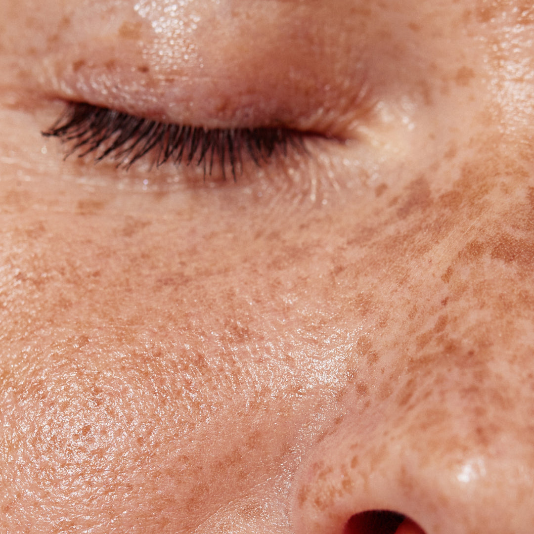 Pigmentation & Hyperpigmentation: Why It Happens and How to Treat It Safely