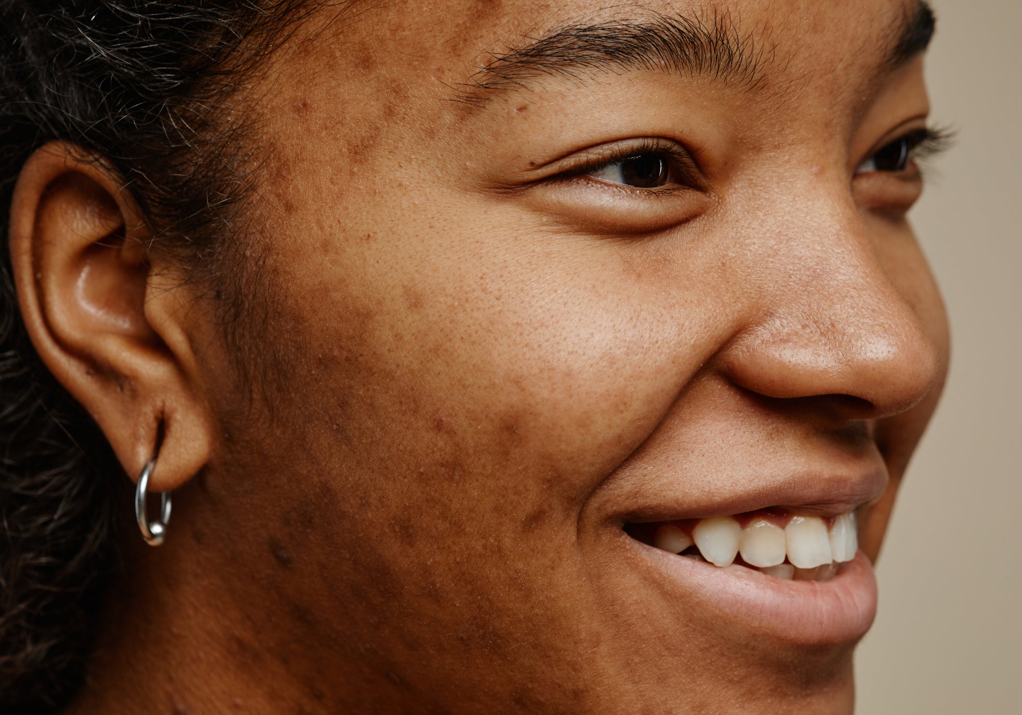 Skincare For Hyperpigmentation