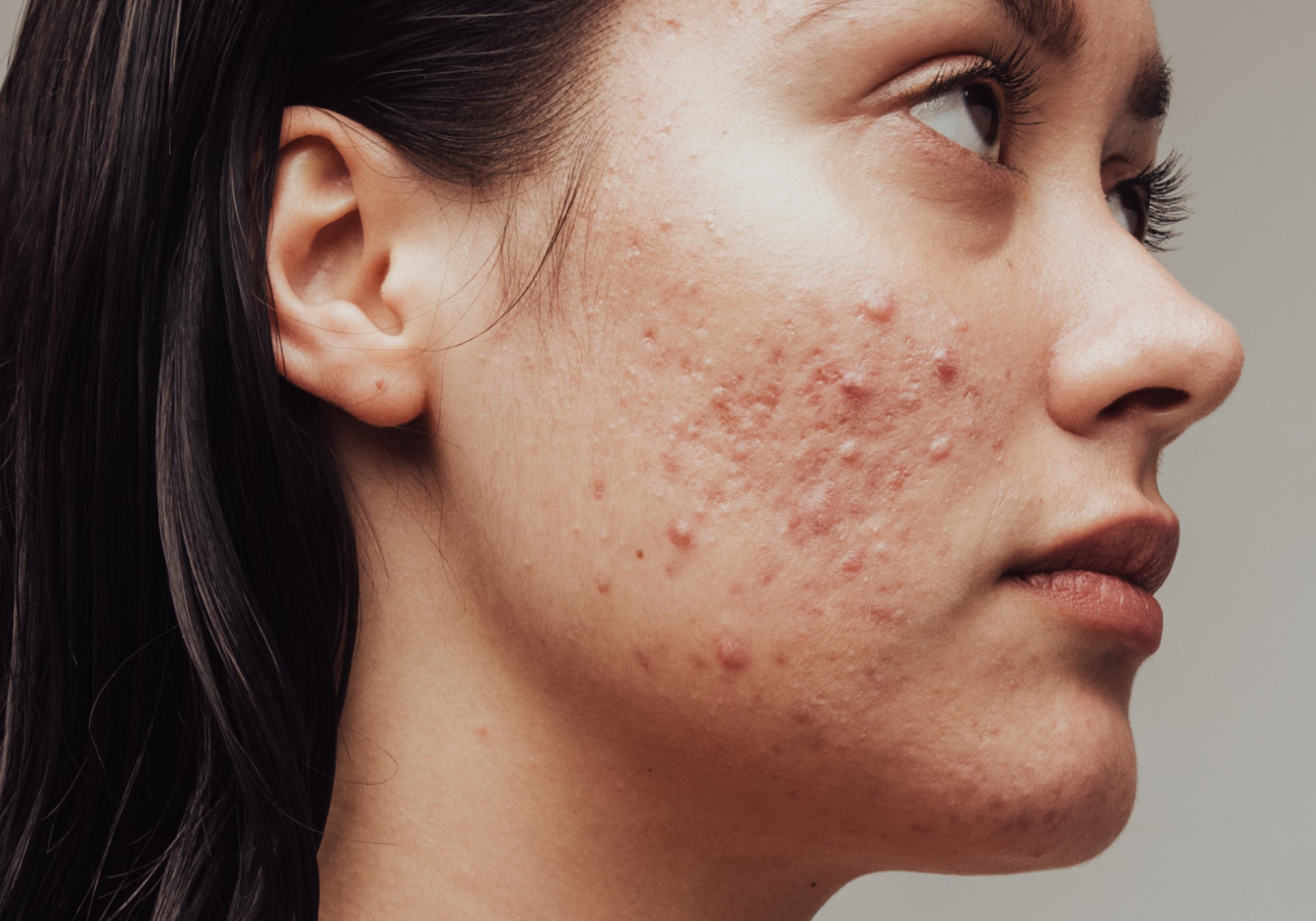 Skincare for Acne-prone Skin