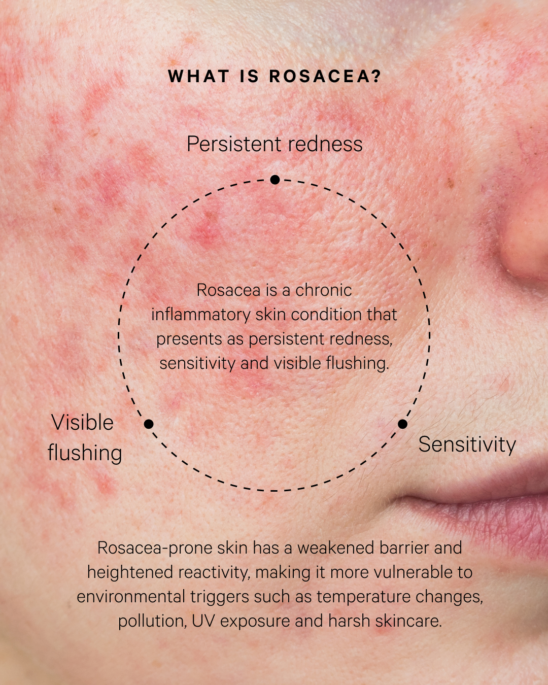 The Rosacea Kit