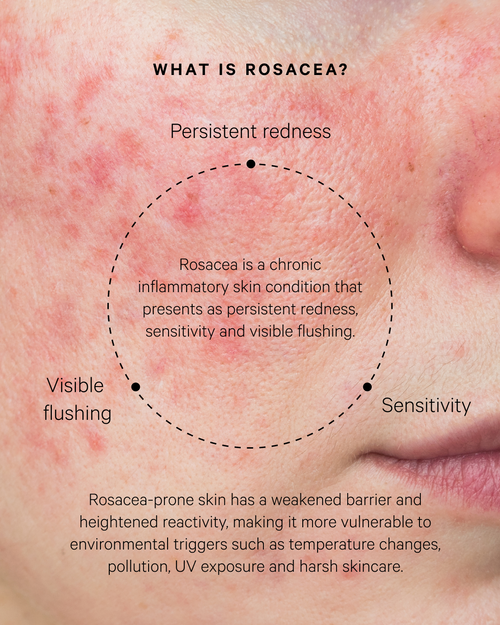 The Rosacea Kit
